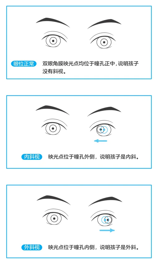 用角膜映光点辅助观察内斜视和外斜视的示意