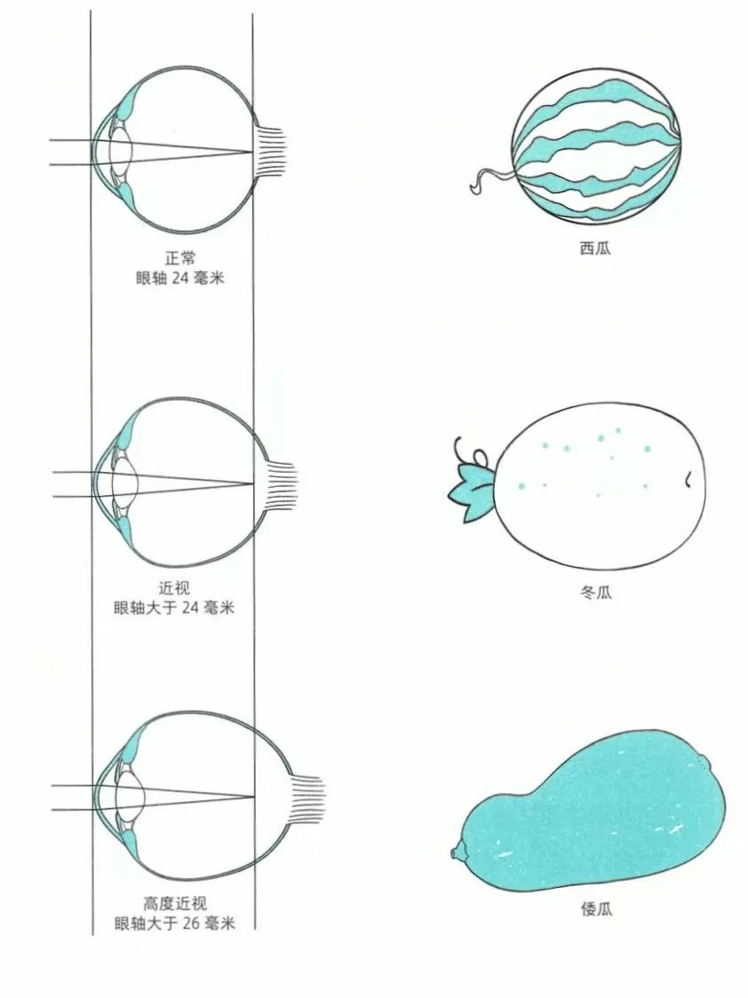 金铂精读资料图:眼轴与近视程度