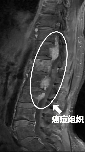 40岁男性病例脊柱核磁影像：白圈与箭头标记癌症组织