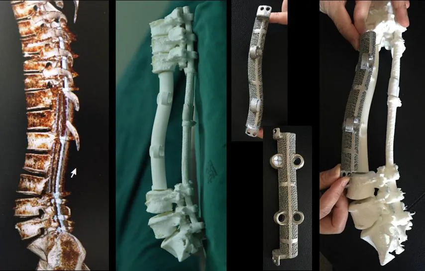 病例的脊柱影像、模型与3D打印钛合金人工椎体对照