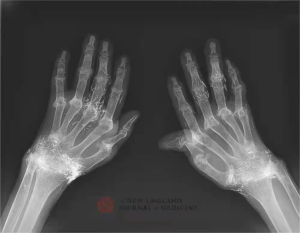类风湿患者双手X光片，手指及腕部关节周围有大量金线，显示原文所述的关节畸形