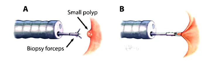 内镜活检钳夹除小息肉的A、B两步示意，保留Small polyp与Biopsy forceps原图标注（课程原图）
