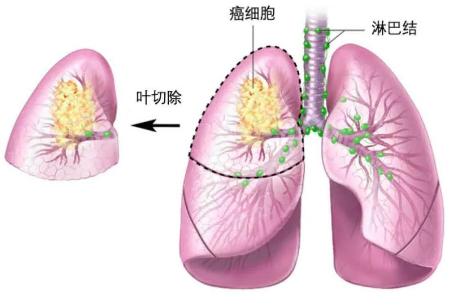 非小细胞肺癌叶切除术示意图