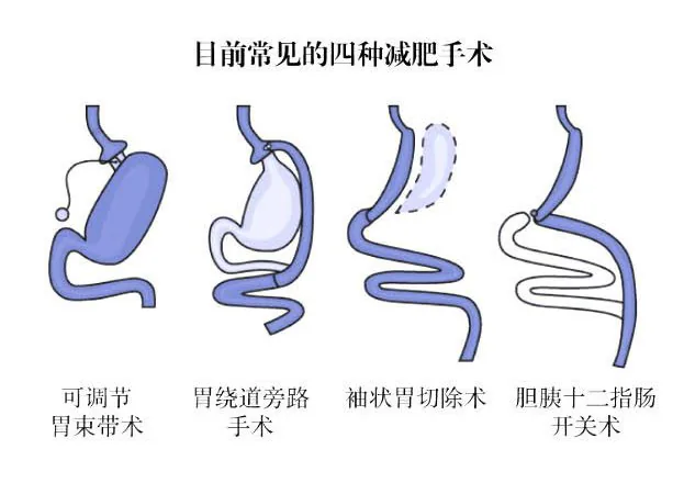 目前常见的四种减肥手术：可调节胃束带术、胃绕道旁路手术、袖状胃切除术、胆胰十二指肠开关术