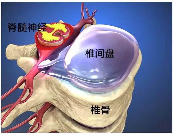 椎骨、椎间盘与脊髓神经的位置关系